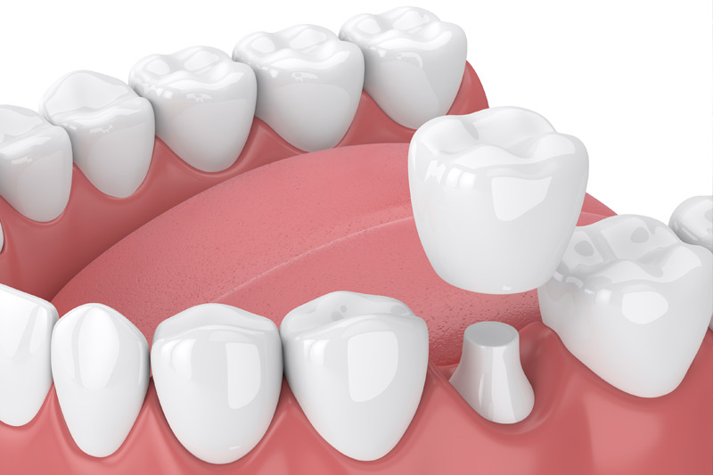 Dental Treatments in Odessa