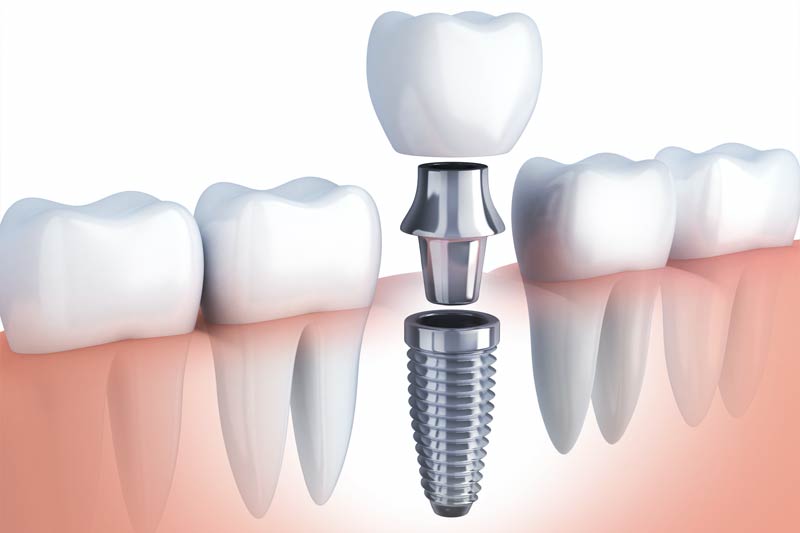 Implants Dentist in Odessa